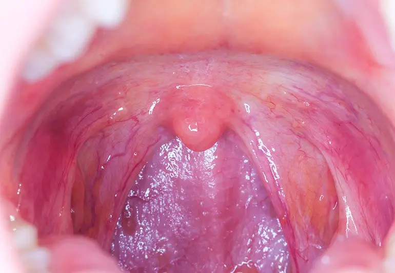 Map: Can I Get Cancer from Oral Sex?
