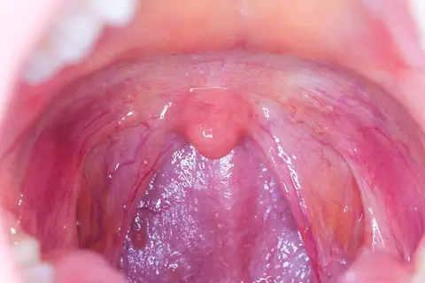 Map: Can I Get Cancer from Oral Sex?