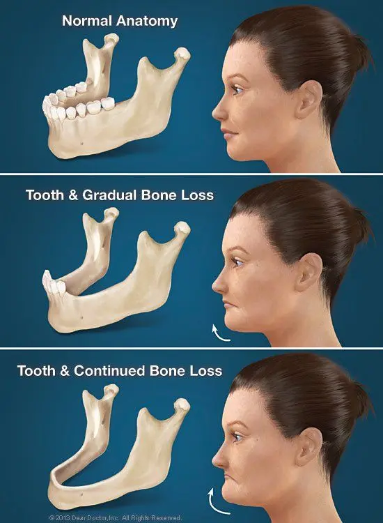 Map: Hidden Consequences of Losing Teeth