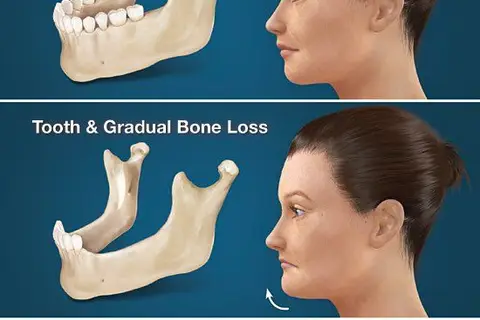 Map: Hidden Consequences of Losing Teeth